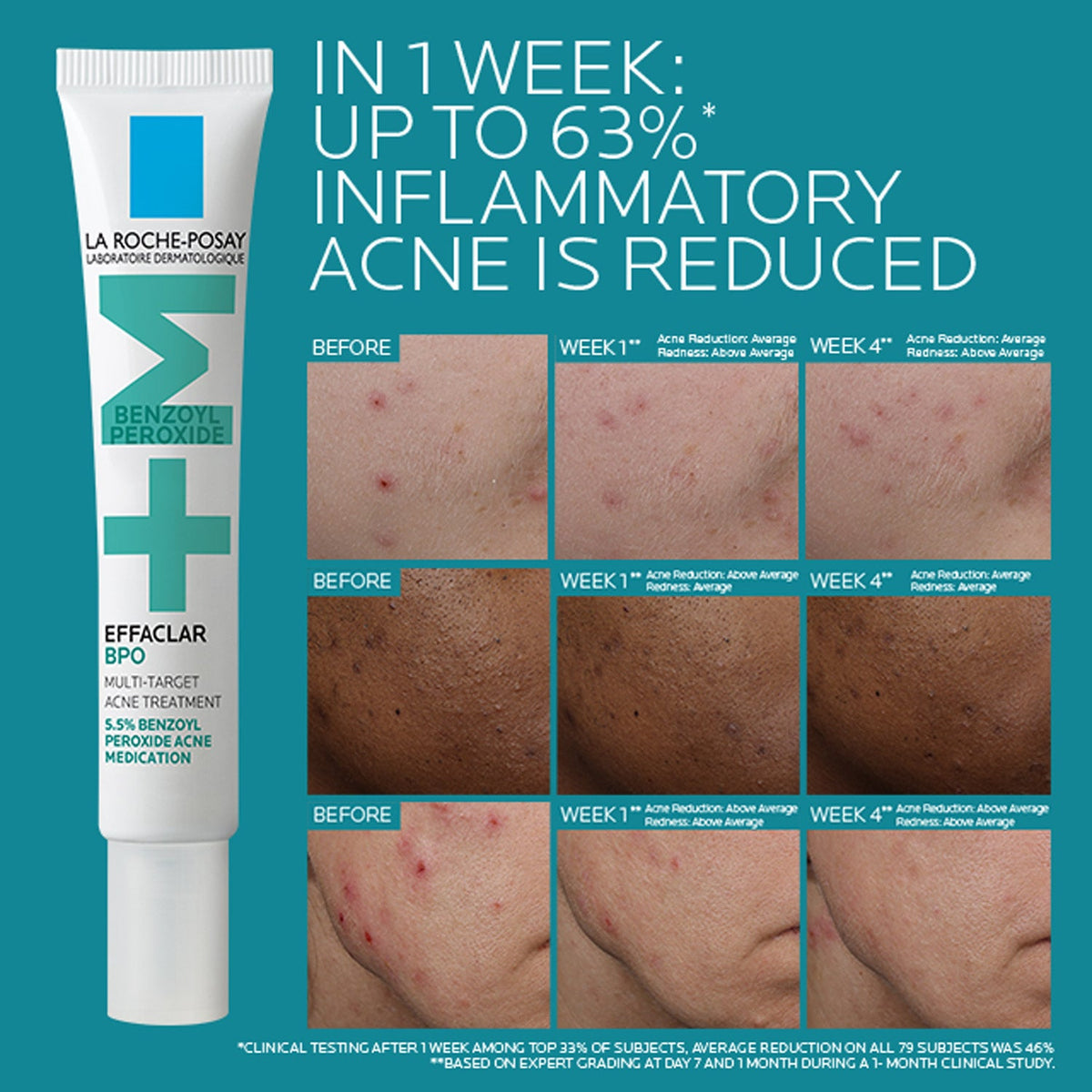 Effaclar BPO Multi-Target Acne Treatment with 5.5% Benzoyl Peroxide